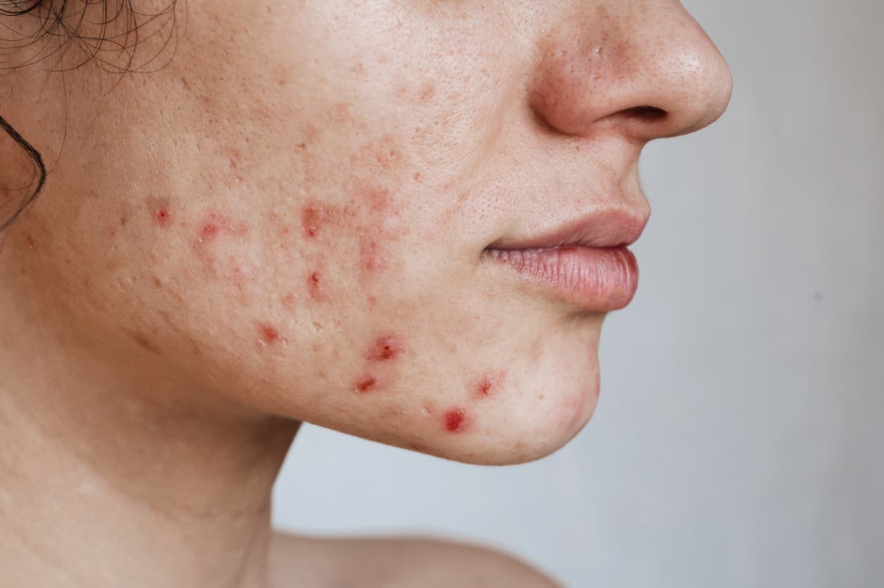 Acne vulgar and oxidative stress