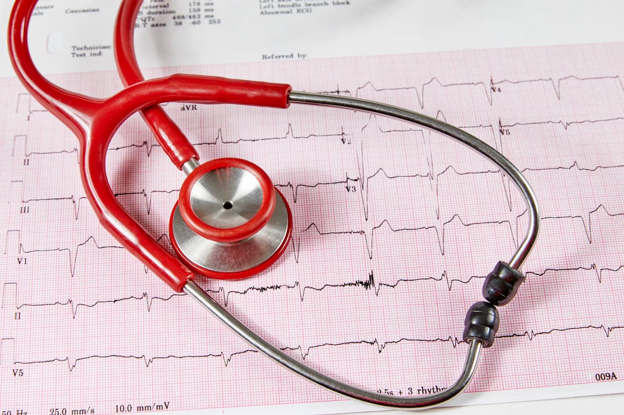 Sweetened beverages and atrial fibrillation