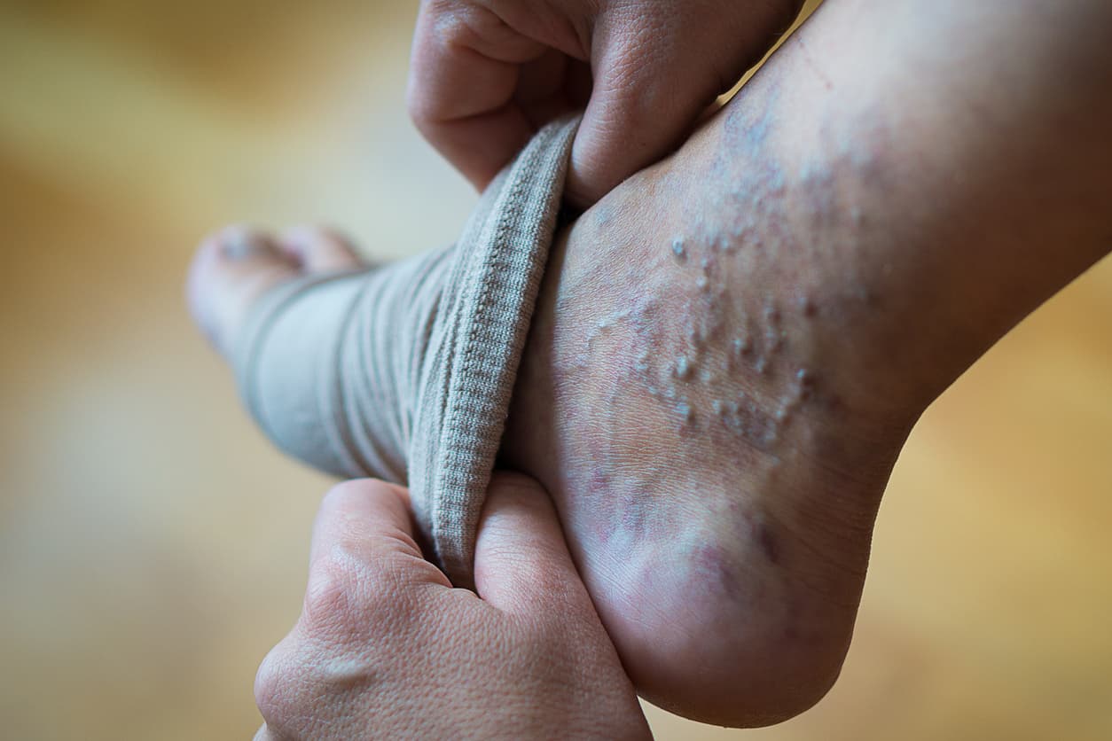 Venous compression to prevent leg ulcer recurrence