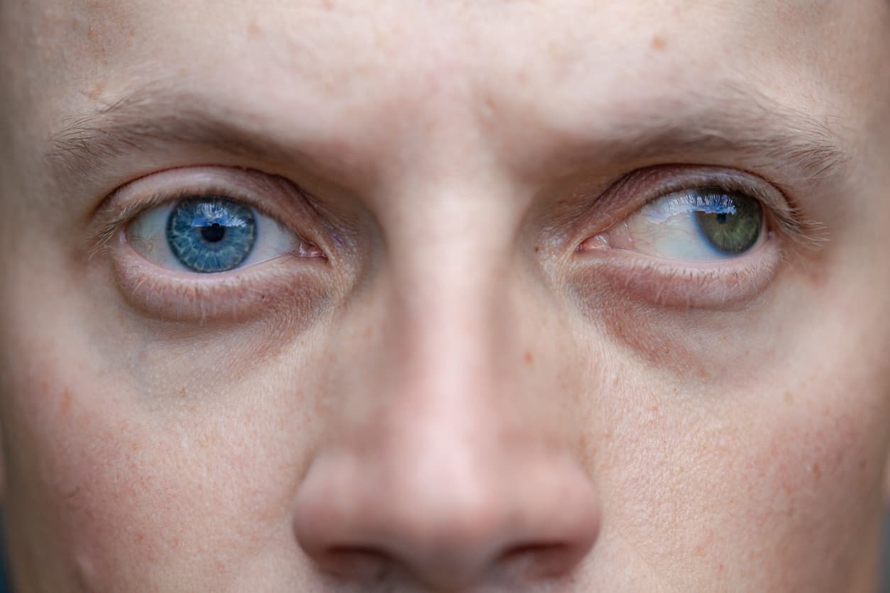 Dexmedetomidine: a revolution in anesthesia for strabismus surgery