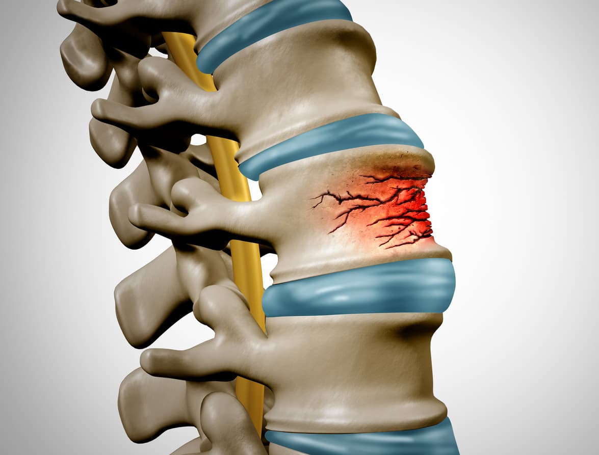 Inflammation in fractures of the lumbar vertebrae and pelvis