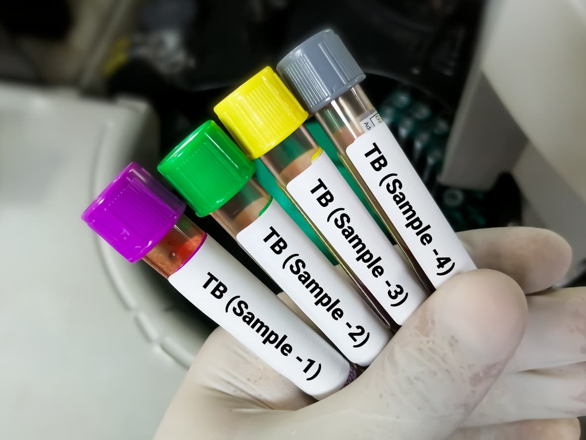 The burden of tuberculosis in adolescents and young adults