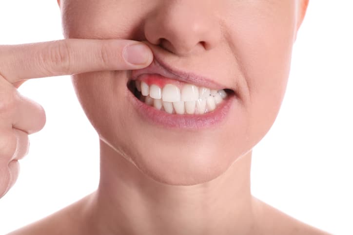 Le point de vue des patients et des chirurgiens-dentistes sur la gingivite !