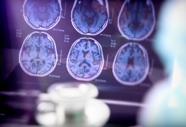 Alzheimer’s Disease: The Amyloid Hypothesis Is Not the Only Factor