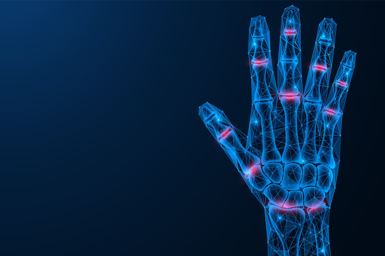 Psoriatic arthritis of the hand and nail psoriasis