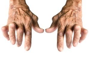 Increased consumption of dietary retinol may protect against rheumatoid arthritis