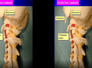 Jon H. Robertson · A far-lateral approach for removal of a C1--2 extradural neurofibroma (3D)