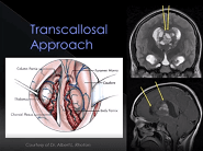 Aaron A. Cohen-Gadol · Interhemispheric transcallosal route for resection of anterior third ventricular lesions