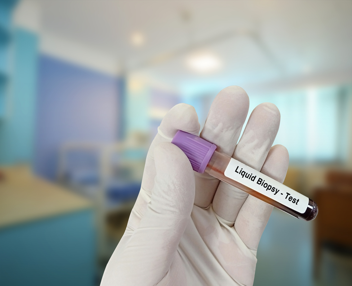 cfDNA put to the test in lung cancer screening cfDNA put to the test in lung cancer screening