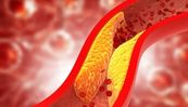Maladie des emboles de cholestérol post-coronarographie : incidence, facteurs de risque et pronostic