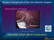 Adjustable Gastric Band Complications Adjustable Gastric Band Complications