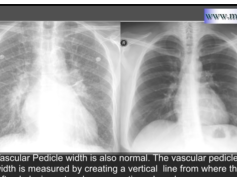 Medflixs - Chest x - ray interpretation by academyofprofessionals