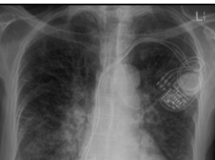 Chest x - ray interpretation by academyofprofessionals