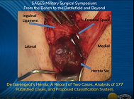 De Garengeots Hernia: A Report of Two Cases De Garengeots Hernia: A Report of Two Cases
