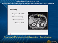 Endoscopic Management of Gastrostomy Complications Endoscopic Management of Gastrostomy Complications