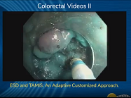 ESD and TAMIS: An Adaptive Customized Approach ESD and TAMIS: An Adaptive Customized Approach
