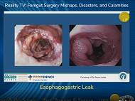 Esophagogastric Leak Esophagogastric Leak