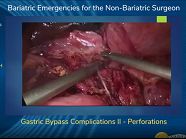 Gastric Bypass Complications II - Perforations Gastric Bypass Complications II - Perforations