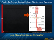 Intra-Operative Bougie Perforation Intra-Operative Bougie Perforation