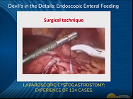 LAPAROSCOPIC CYSTOGASTROSTOMY: EXPERIENCE OF 134 CASES LAPAROSCOPIC CYSTOGASTROSTOMY: EXPERIENCE OF 134 CASES