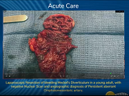 Laparoscopic Resection of bleeding Meckel's Diverticulum in a young adult Laparoscopic Resection of bleeding Meckel's Diverticulum in a young adult