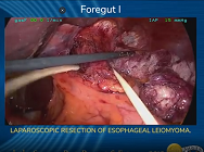 LAPAROSCOPIC RESECTION OF ESOPHAGEAL LEIOMYOMA LAPAROSCOPIC RESECTION OF ESOPHAGEAL LEIOMYOMA