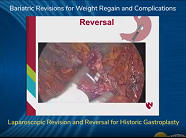 Laparoscopic Revision and Reversal for Historic Gastroplasty Laparoscopic Revision and Reversal for Historic Gastroplasty