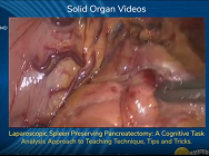 Laparoscopic Spleen Preserving Pancreatectomy Laparoscopic Spleen Preserving Pancreatectomy