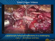 Laparoscopic total pancreatectomy in a challenging case----technique and tips Laparoscopic total pancreatectomy in a challenging case----technique and tips