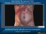 LAPAROSCOPIC VENTRAL HERNIA REPAIR IN A LIVER TRANSPLANT PATIENT LAPAROSCOPIC VENTRAL HERNIA REPAIR IN A LIVER TRANSPLANT PATIENT