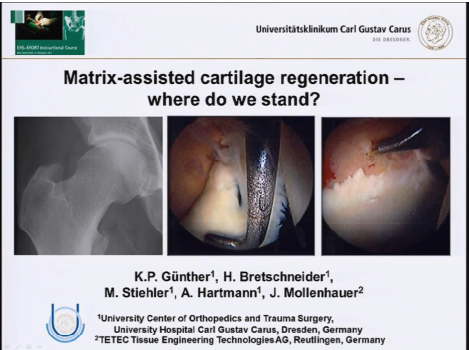 Matrix assisted cartilage regeneration - where do we stand? Matrix assisted cartilage regeneration - where do we stand?