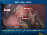 Minimally Invasive Splenectomy For ITP During Pregnancy Minimally Invasive Splenectomy For ITP During Pregnancy