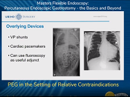 PEG in the Setting of Relative Contraindications PEG in the Setting of Relative Contraindications