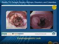 Prohylactic Mesh for Parastomal Hernias? Prohylactic Mesh for Parastomal Hernias?