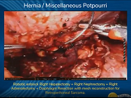 Robotic enblock Right Hepatectomy + Right Nephrectomy + Right Adrenalectomy Robotic enblock Right Hepatectomy + Right Nephrectomy + Right Adrenalectomy