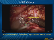 Robotic Repair of Choledocho- right hepatic arterial fistula Robotic Repair of Choledocho- right hepatic arterial fistula