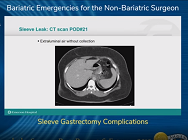 Sleeve Gastrectomy Complications Sleeve Gastrectomy Complications