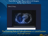 The Evolving Role of Chemoradiation +/- Local Excision for Liver Cancer The Evolving Role of Chemoradiation +/- Local Excision for Liver Cancer