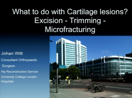 What to do with cartilage lesions? Excision - Trimming - Microfracturing What to do with cartilage lesions? Excision - Trimming - Microfracturing